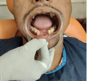 Best Clinics for Missing Teeth Replacement in Barasat: Exploring Your Options for a Complete Smile